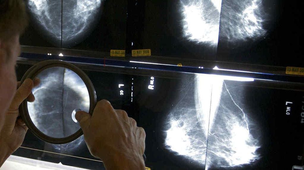 Estudio por imágenes para la detección de cáncer de mama. 