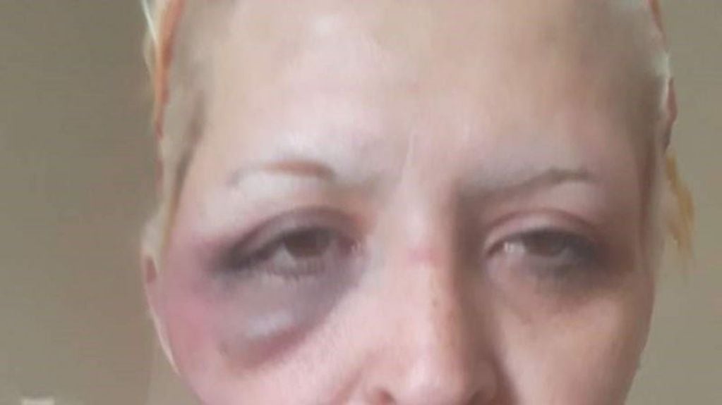 Así quedó el rostro de la mujer musulmana atacada por su vecina.
