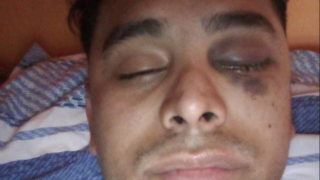 Federico Zárate recibió un golpe por el dueño del departamento que alquilaba y perdió un ojo.