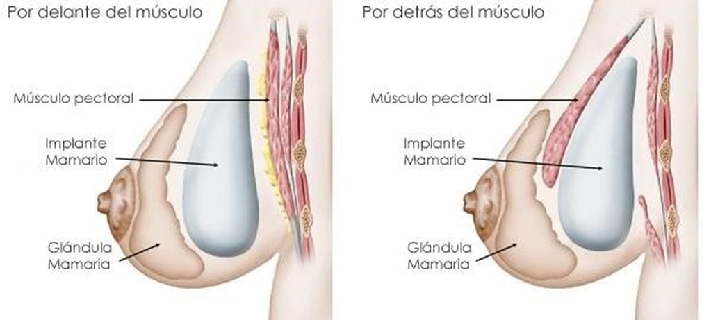 Los implantes se pueden colocar detrás del músculo pectoral o de la glándula mamaria (Foto: Diario Junin).