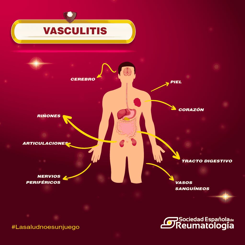 Vasculitis