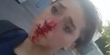 Martina Vallejos, de 13 años, con la nariz ensangrentada por un golpe.