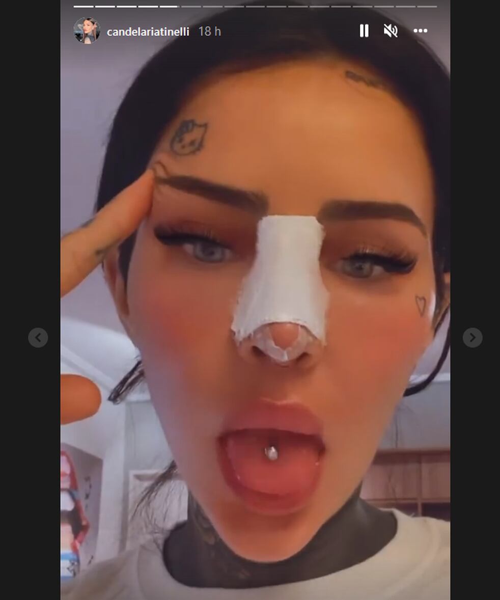 Cande Tinelli tras su cirugía en la nariz. (Foto: Instagram)