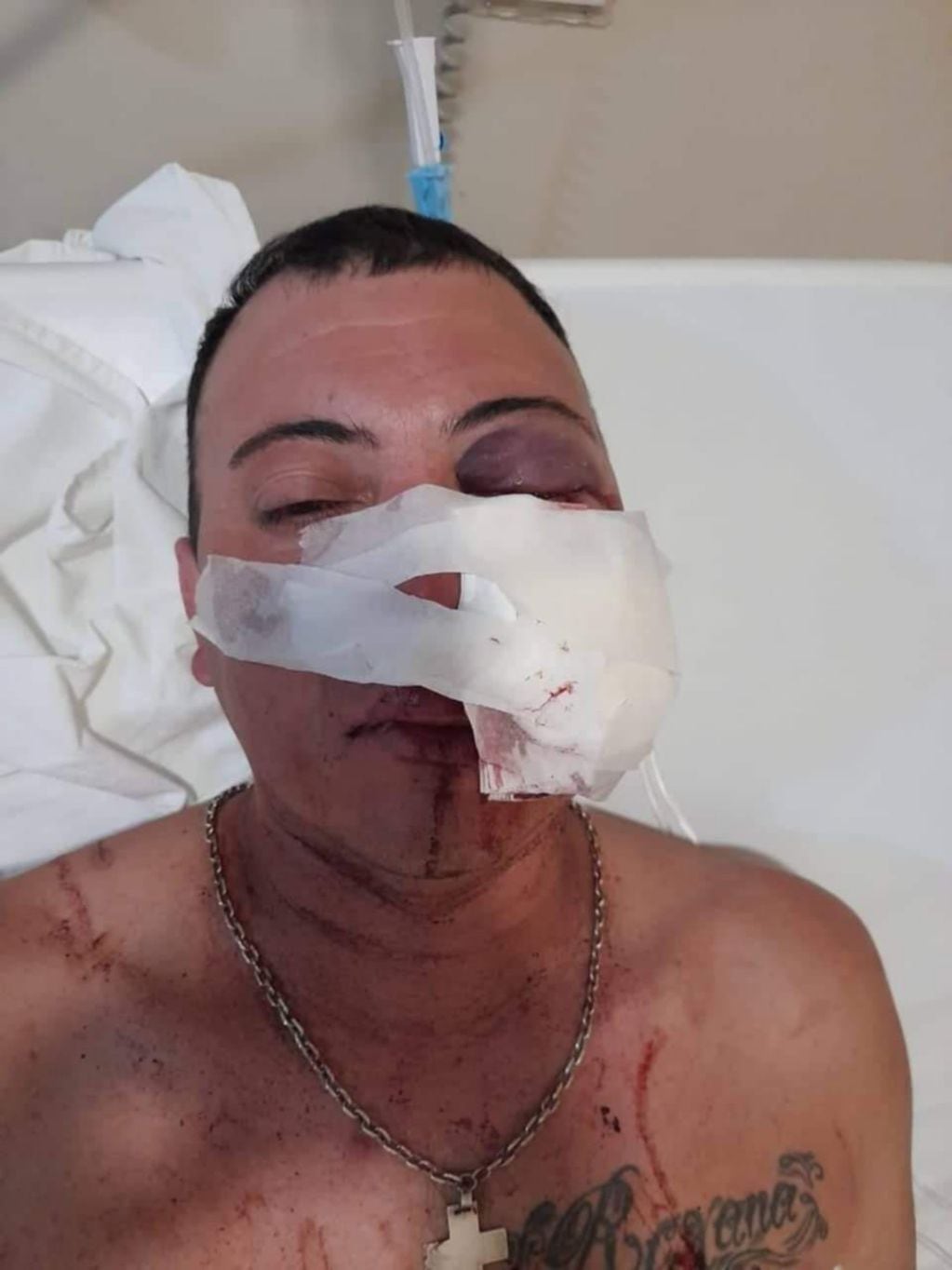 Rodrigo Arballo perdió su ojo izquierdo a raíz de una bala de goma.