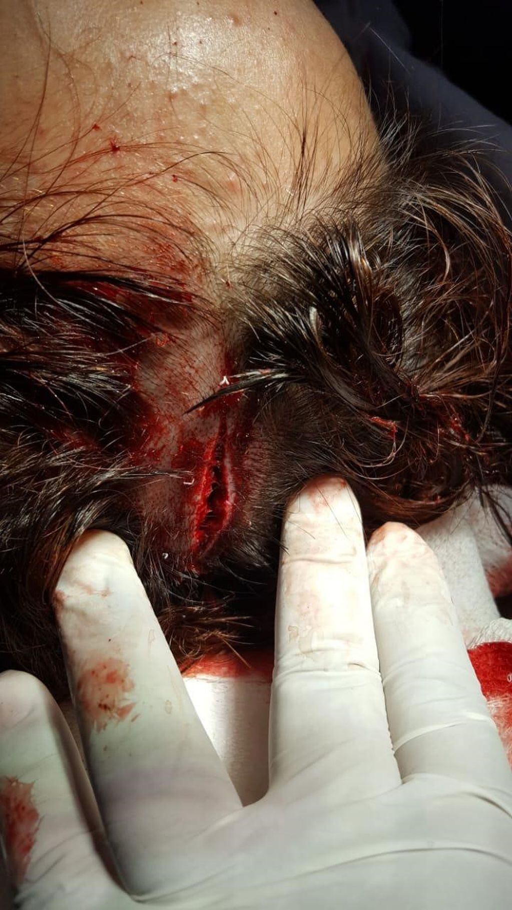 Herida en la cabeza de una de las jóvenes que un sujeto rapto en cercanías de la estancia "Las Violetas"