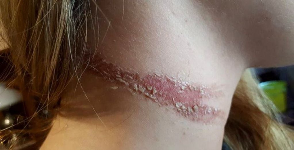El cuello lastimado de la joven pergaminense tras el ataque de un motochorro.