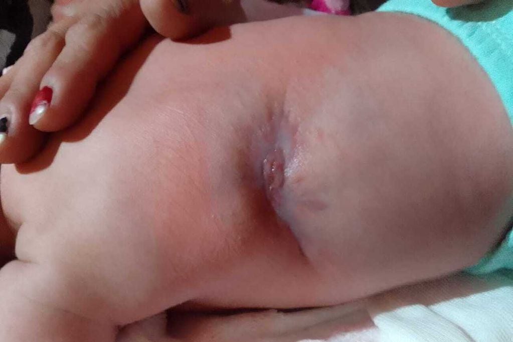 Lesiones de la bebé PM por prácticas bajo sospecha en el Hospital Materno Neonatal. Fotos autorizadas y gentileza de la familia