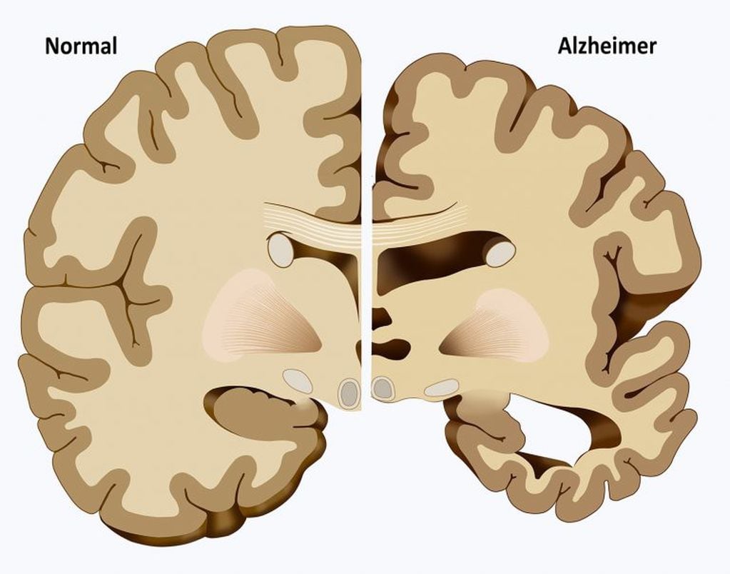 El Alzheimer perjudica la memoria, el razonamiento y la conducta (Web)