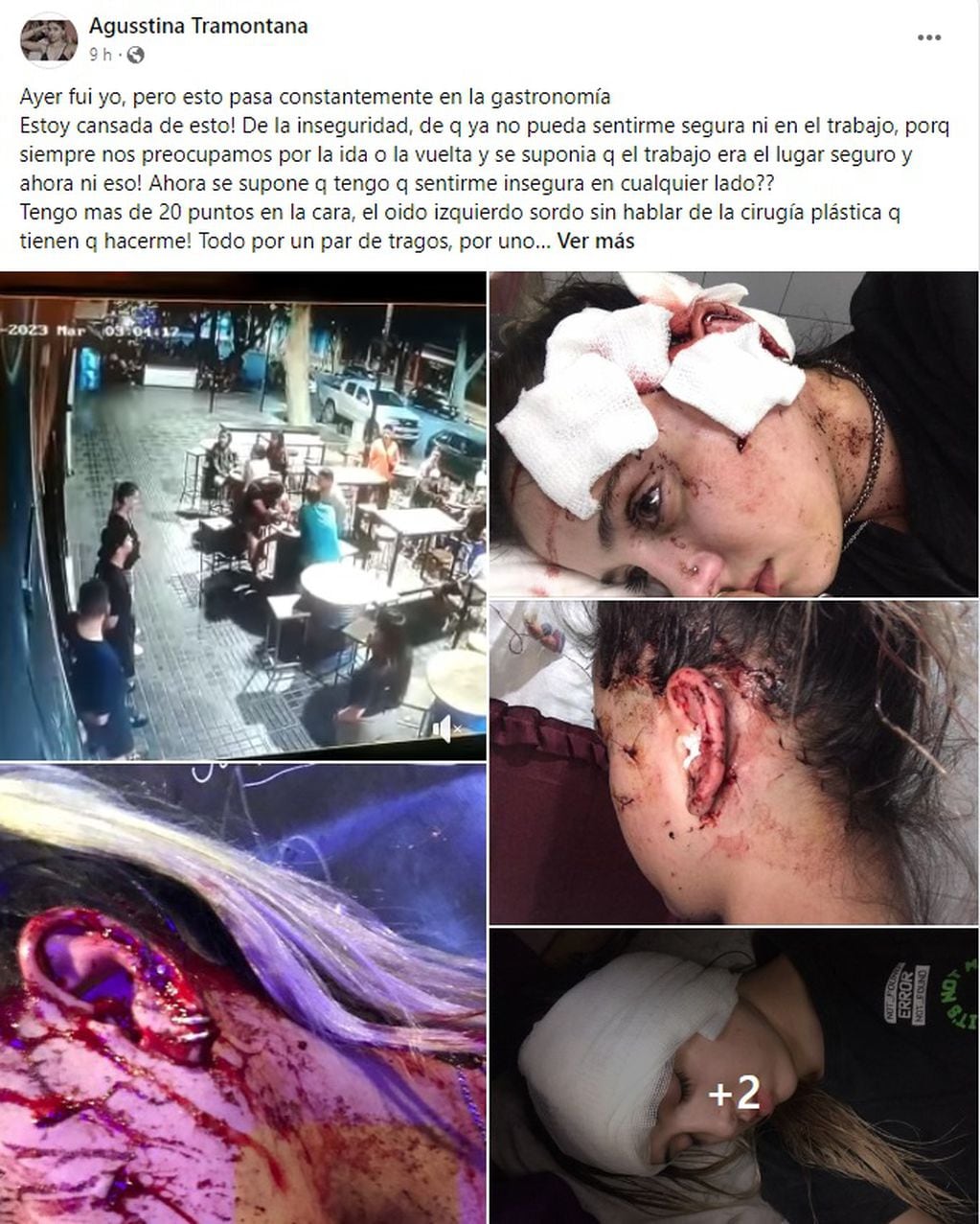 Agustina Tramontana publicó en cuenta de Facebook, las fotos luego del ataque del que fue víctima en un bar de Mendoza.