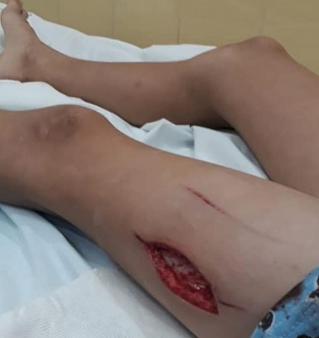 Niño herido al caer por el mal estado de juegos infantiles en Plaza 3 de Agosto en Queqén
