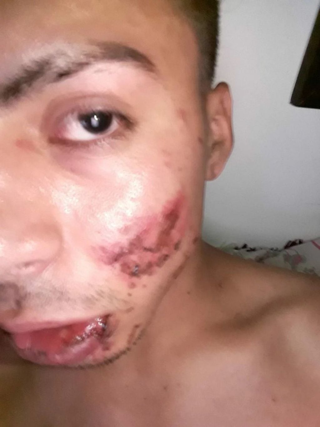 Así quedó el joven atacado salvajemente por un patovica a la salida de un boliche en San Miguel, provincia de Buenos Aires.