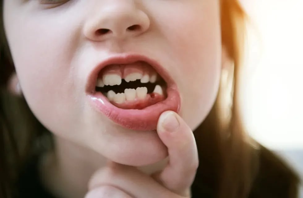 Insólito caso de una niña que se volvió viral por tener 81 dientes | Imagen Referencial.