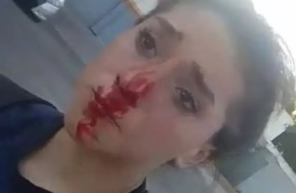 Martina Vallejos, de 13 años, con la nariz ensangrentada por el golpe de su agresor.