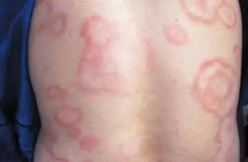 Síntomas de lepra. Imagen ilustrativa. (WEB)