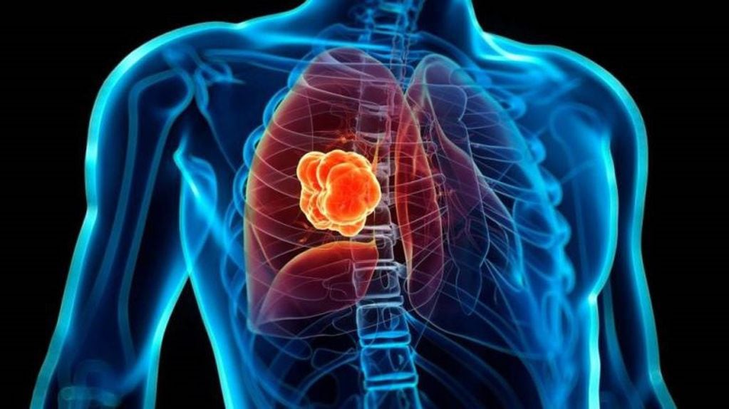 El cáncer de pulmón representa la tercera causa de muerte por cáncer en la Argentina.