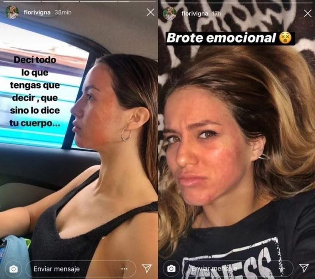 Flor Vigna padece un brote facial que decidió compartir con sus seguidores (Instagram/florvigna)