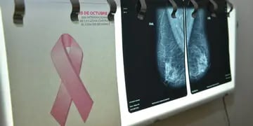 CÁNCER. El cáncer de mama sigue siendo el que más muertes provoca: 627 mil al año. (La Voz/ Archivo)