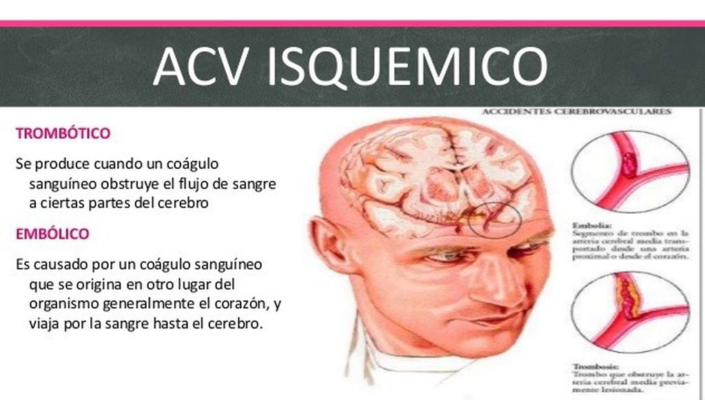 ACV: accidente cerebro vascular.
