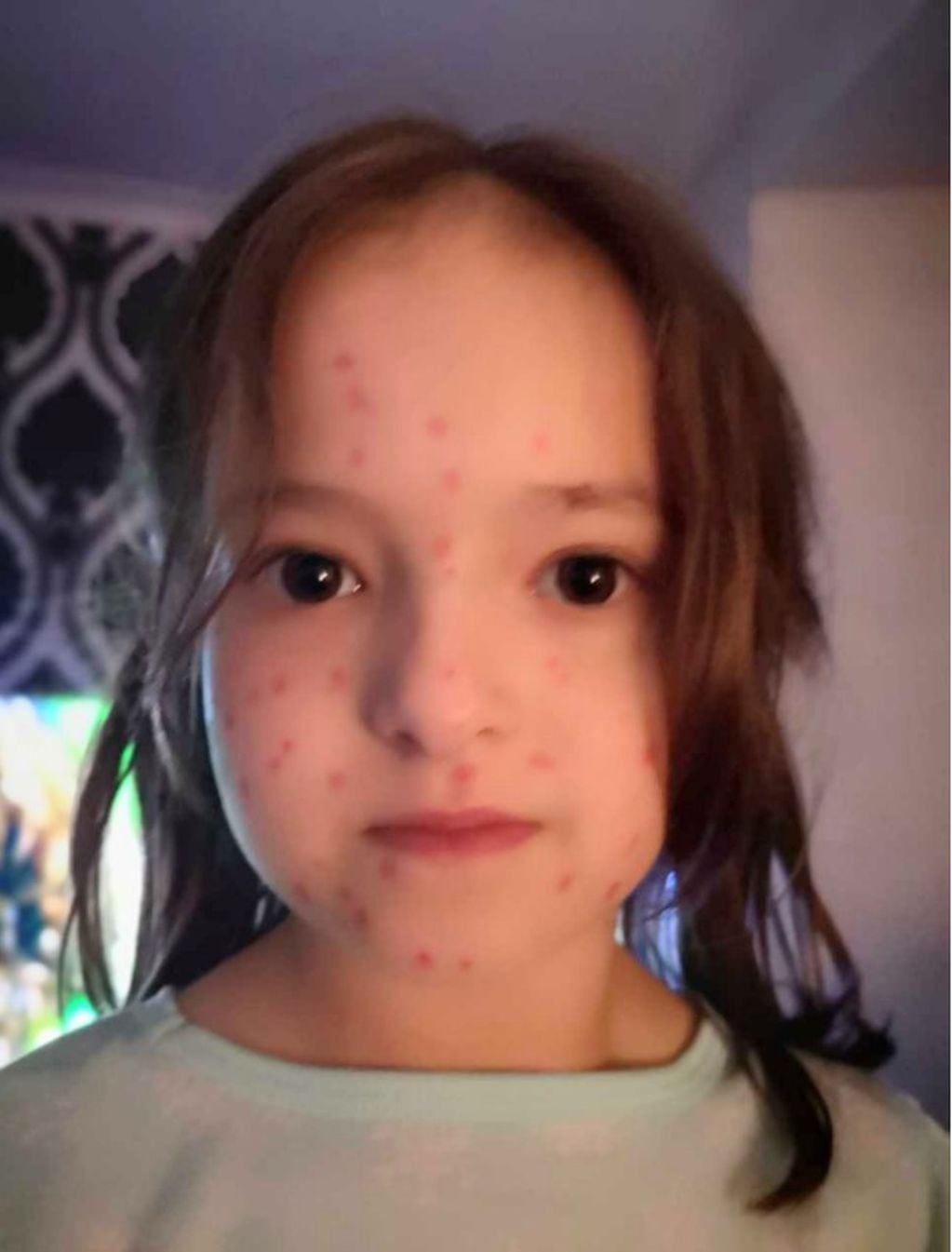 Lily Schooley, una niña inglesa de seis años, quiso evitar un examen y se pintó manchas rojas en la piel (foto: Facebook)
