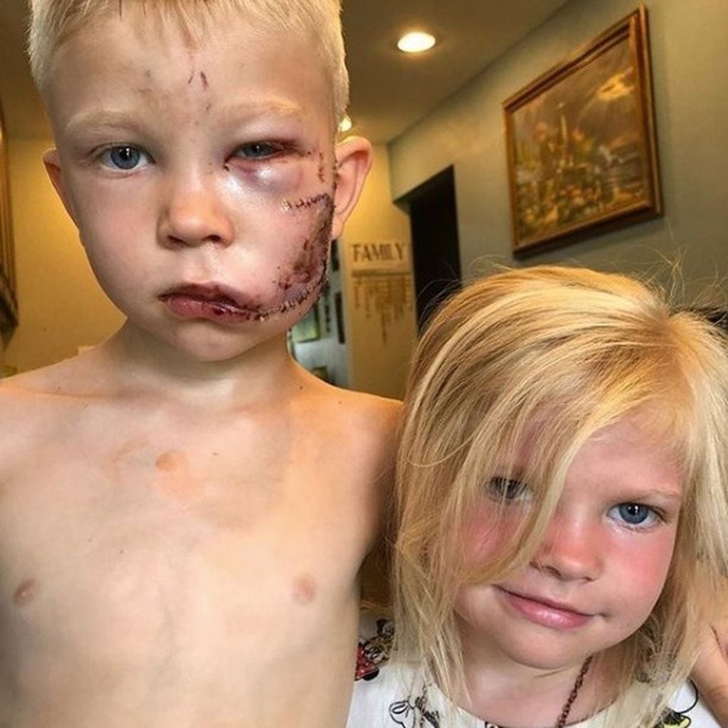 Un nene de seis años le salvó a su hermana al interponerse en el ataque de un perro