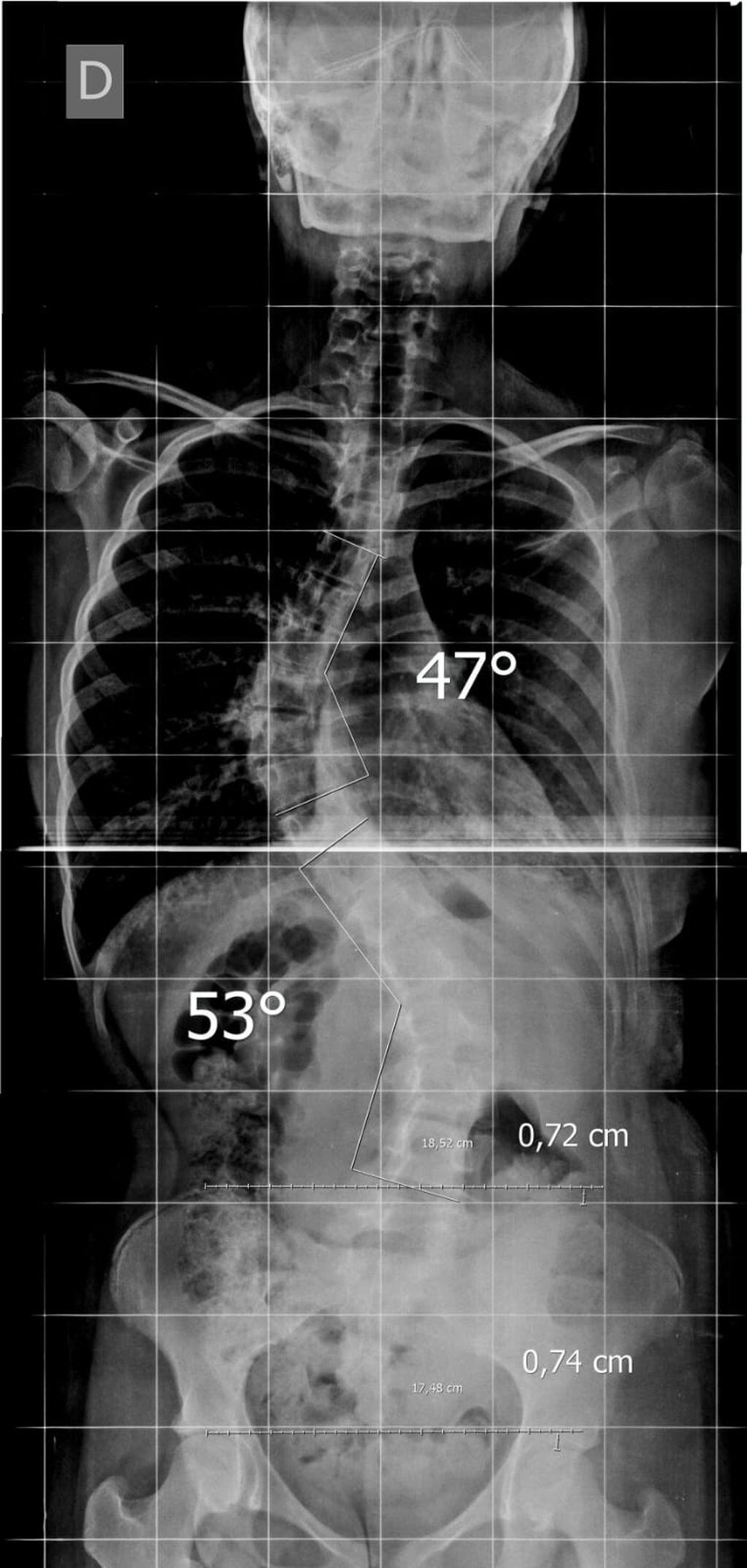 Radiografía de la espalda de Micaela Castro, la joven con escoliosis idiopática que necesita recaudar dinero para su operación