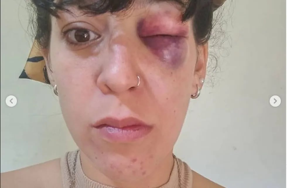Romina Villacorta denunció ser salvajemente golpeada por su pareja en San Luis