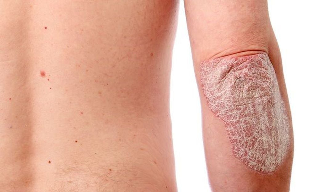 Realizan campaña en Neuquén para prevenir la psoriasis.