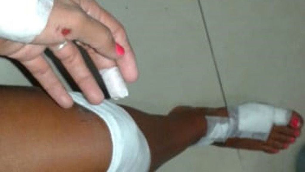 Gisela sufrió lesiones en manos, muslos y un pie. Además, hematoma en mejilla izquierda y heridas en ambas rodillas.