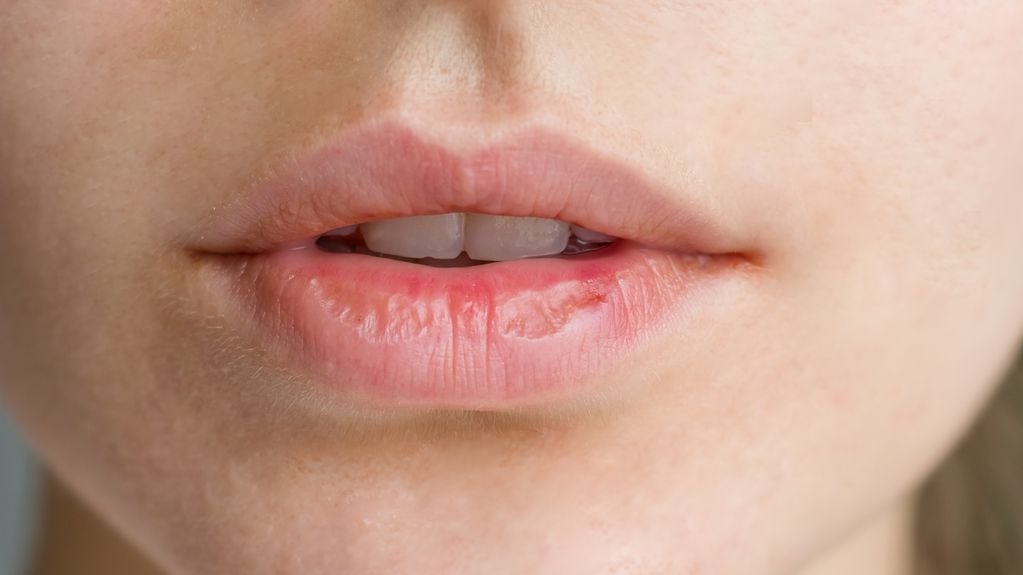 ¿Cómo eliminar los labios agrietados?