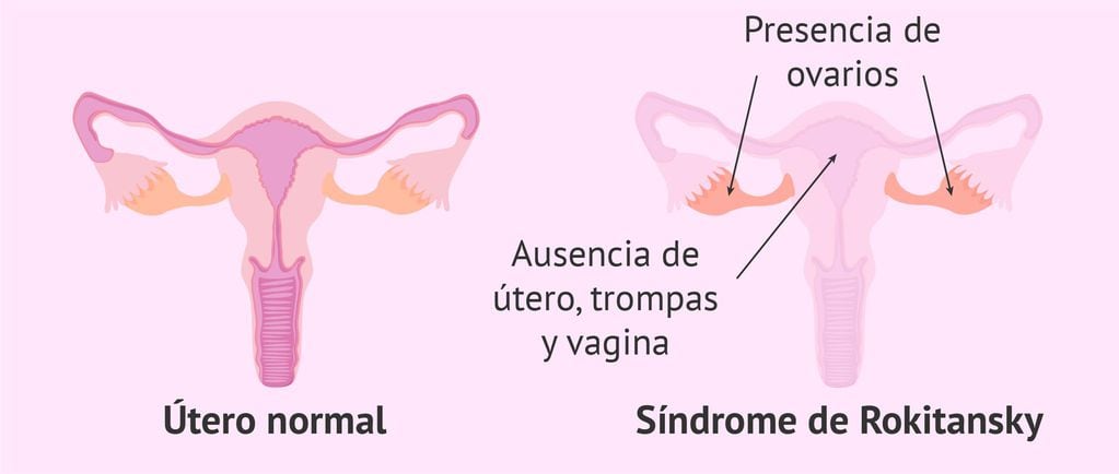 Sindrome de Rokitansky: se registra la ausencia de útero y trompas de Falopio, y en oportunidades de la vagina. 