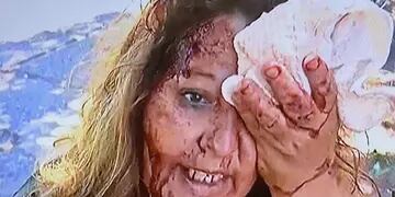 Mujer con el rostro destrozado por culatazos de delincuentes