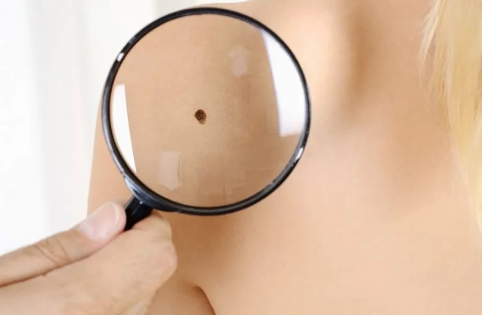 Controles gratuitos para detectar el cáncer de piel.