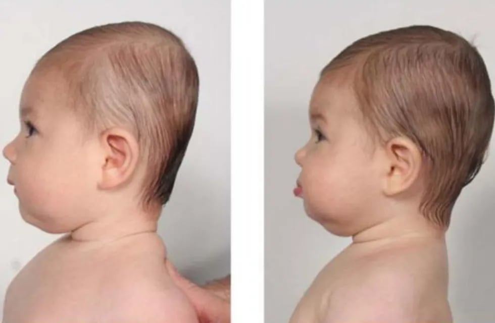 Plagiocefalia, la rara afección que afecta a una beba de 13 meses de San Luis.