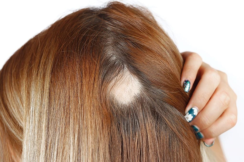 Alopecia areata