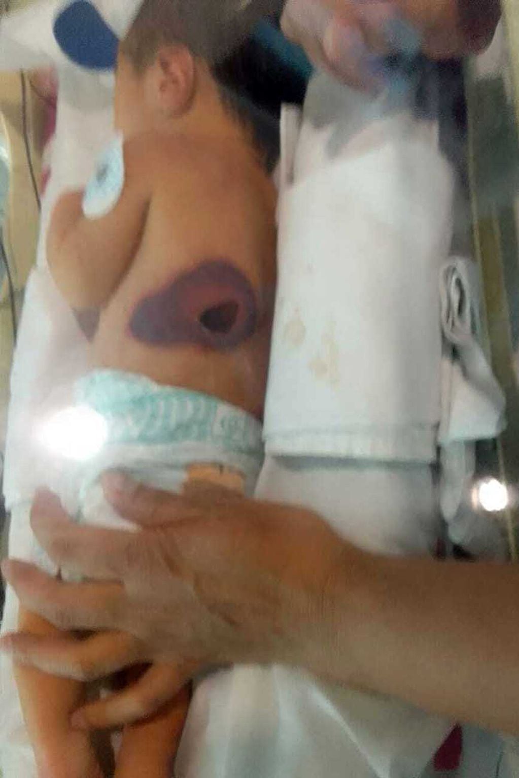 Lesiones de la bebé PM por prácticas bajo sospecha en el Hospital Materno Neonatal. Fotos autorizadas y gentileza de la familia