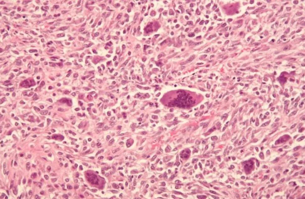 Osteosarcoma (Foto: imagen ilustrativa/web)
