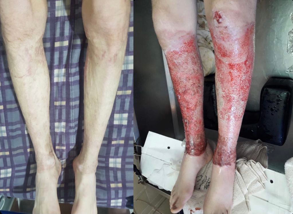 El antes y después de haber utilizado la crema de Dora, de las piernas del joven sanjuanino.