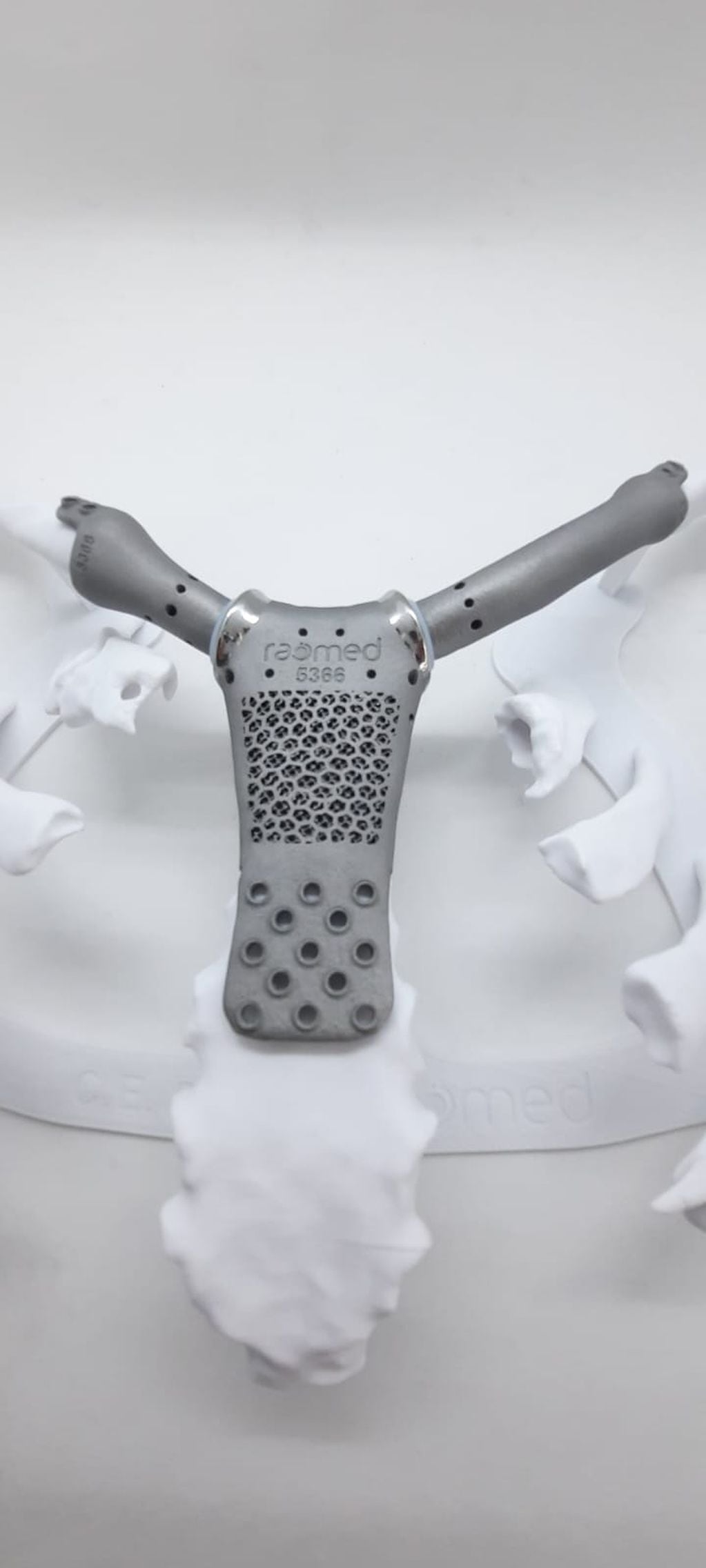 Así es la prótesis que le colocaron a una paciente de 61 años en Córdoba.