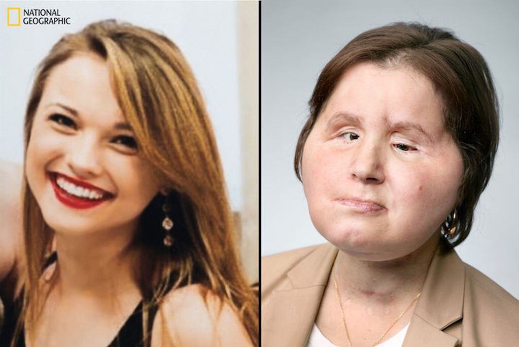 Katie Stubblefield, antes y después del trasplante.