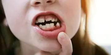 niña 81 dientes