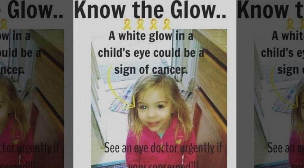 Por esta foto Elly Smith supo que su hija Grace, de dos años, padecía un cáncer ocular llamado retinoblastoma.