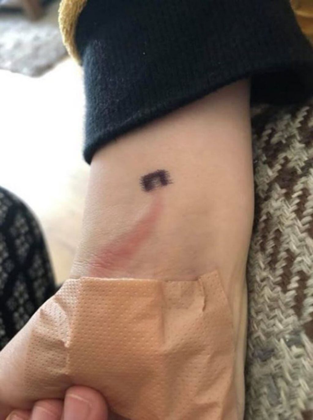 Descubrió una extraña marca roja en el brazo de su hijo y sin saberlo le salvó la vida (Foto: Facebook)