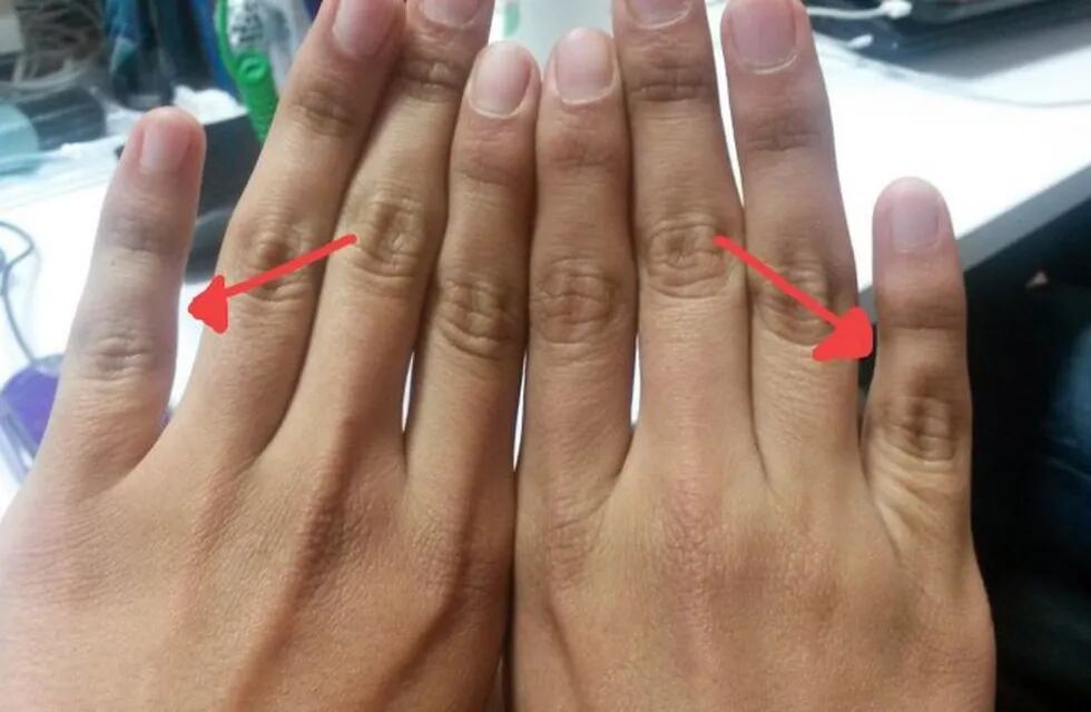 ¿Por qué el dedo meñique está cada vez más alejado del anular?