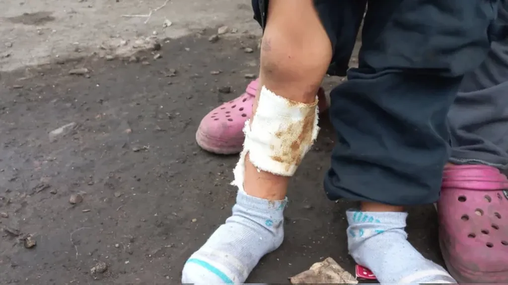 Así se quemó un niño jugando en los terrenos incendiados bajo tierra en Guaymallén.