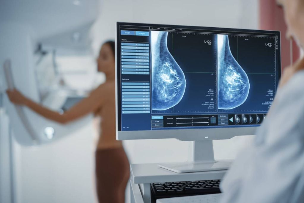 Las mamografías salvan vidas pese a no ser infalibles. (Shutterstock / Gorodenkoff)