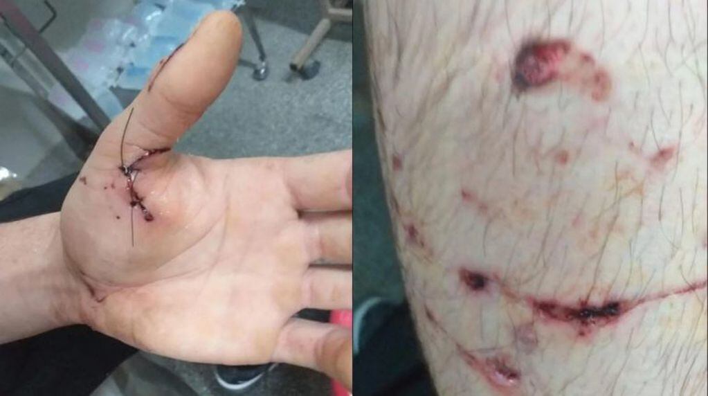Un adolescente fue atacado por un Pitbull en Junín (Web)