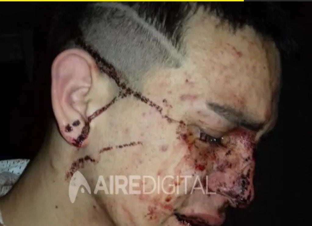 Ezequiel, joven golpeado por un patovica en un boliche santafesino. (Aire de Santa Fe)