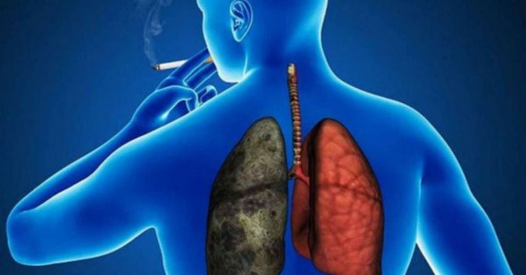 El cáncer de pulmón es el tumor maligno más frecuente a nivel mundial.