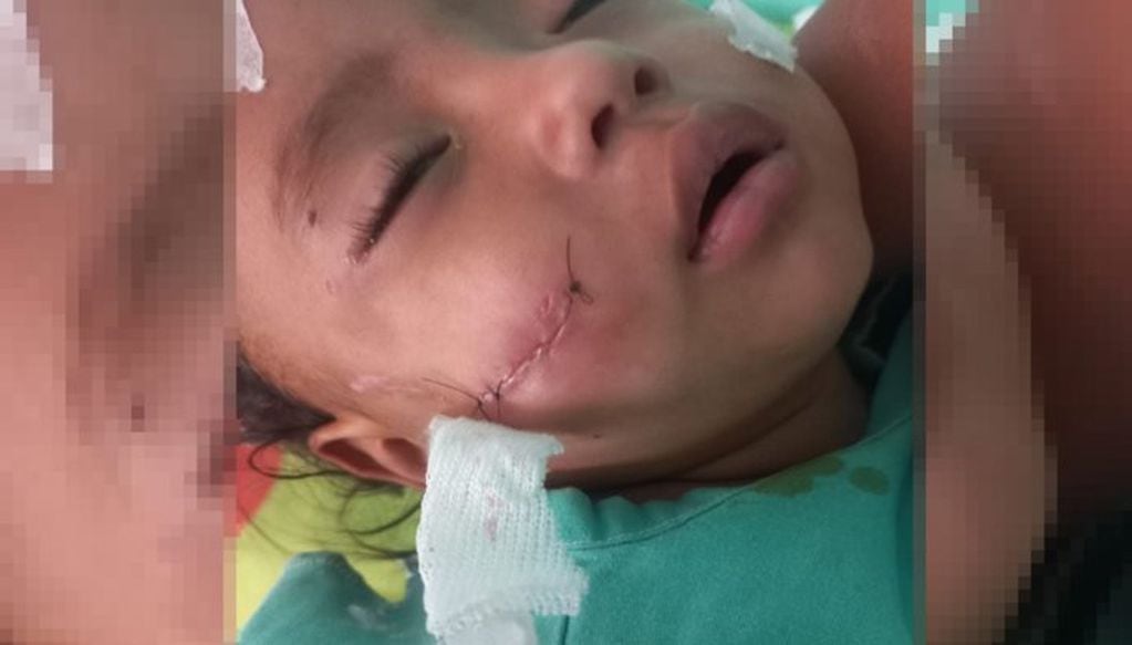 Un médico se enteró de lo que le pasó a la pequeña y viajó desde Salta a Tartagal para operarla.