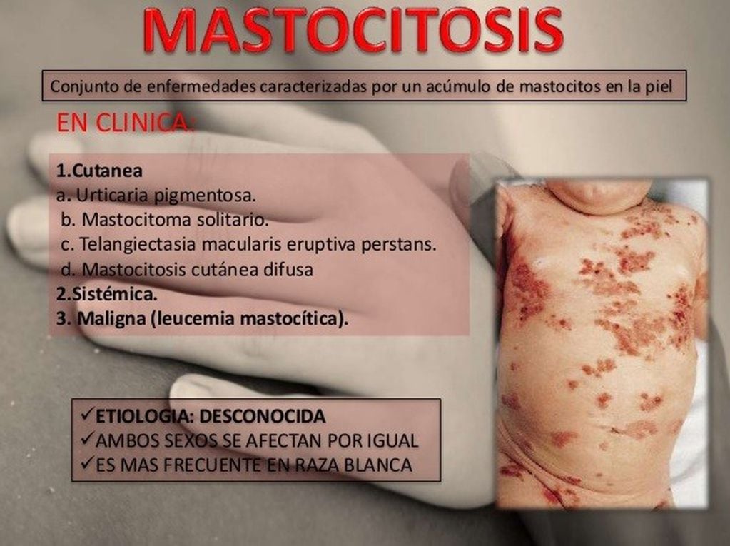 Mastocitosis.